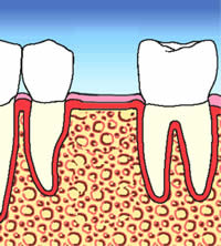 Implant