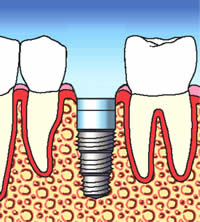 Implant