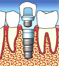 Implant